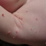 How to Protect Yourself from Molluscum Contagiosum
